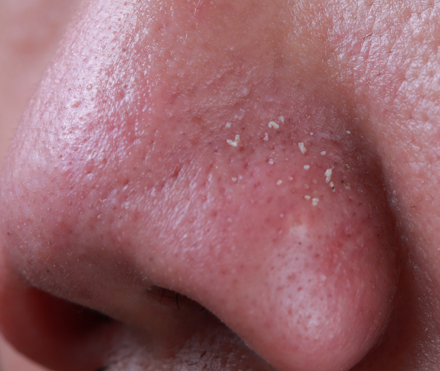 Punti neri o Filamenti Sebacei? Ecco perché strizzarli ti sta rovinando la pelle